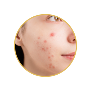 Acne