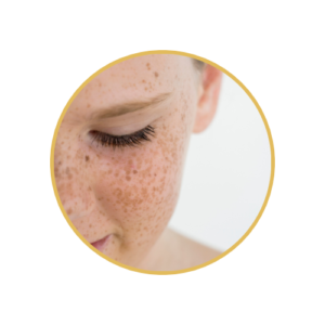 Freckles