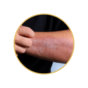 Eczema