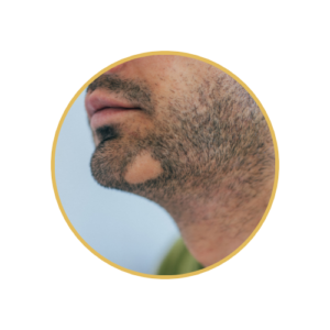 Alopecia Areata