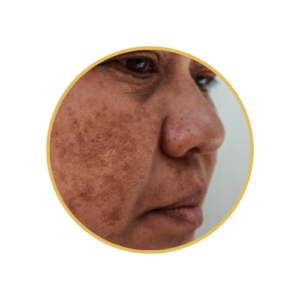 Melasma