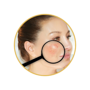 Rosacea