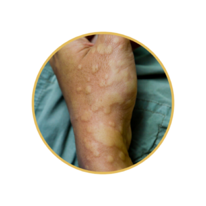 Urticaria