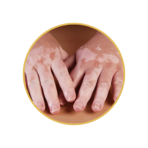 Vitiligo