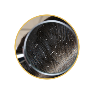 Dandruff