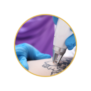 Tattoo Removal
